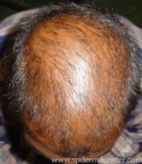 Hair Before